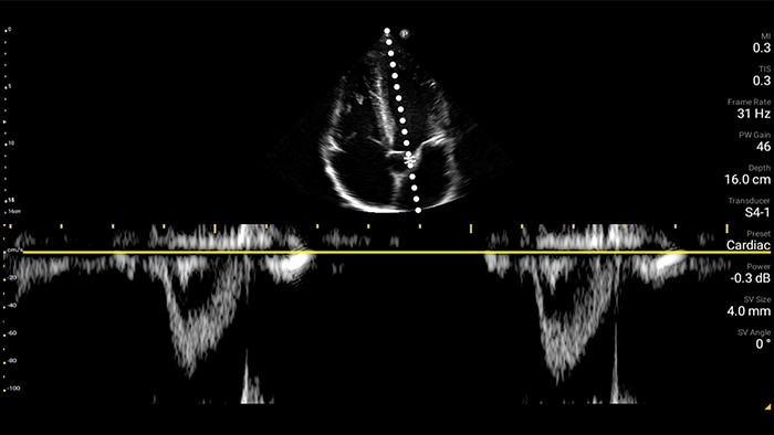 Cardiac thumb second