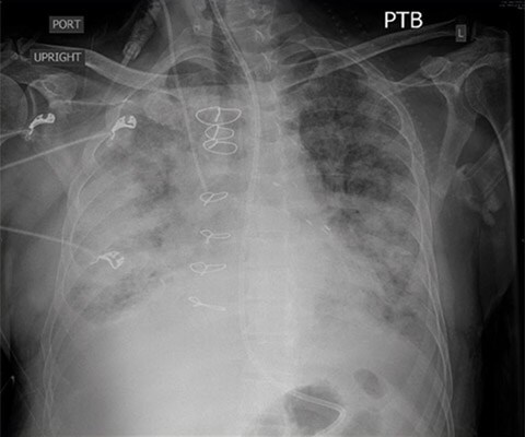 CXR image